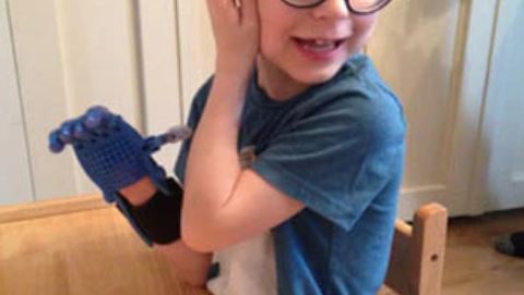 3D Printing Changing Lives